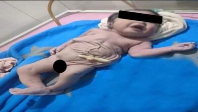 Photo of حالة نادرة محلياً وعالمياً..ولادة طفل بدون “بطن”